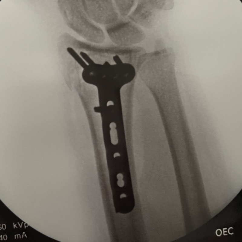 An x-ray of my left ulna and radius showing a silhouette of the metal plate and screws